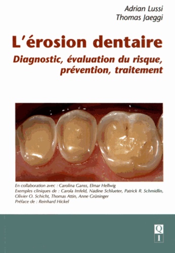 Adrian Lussi et Thomas Jaeggi - L'érosion dentaire - Diagnostic, évaluation du risque, prévention, traitement.