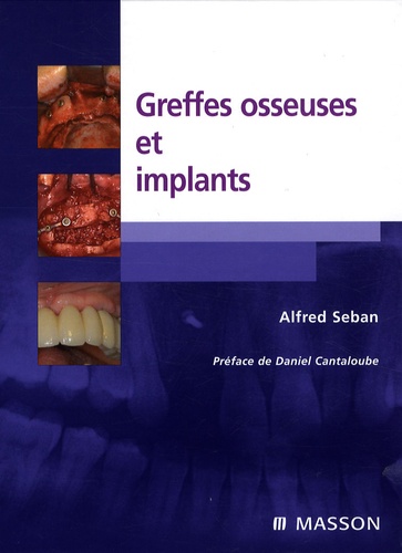Alfred Seban - Greffes osseuses et implants.