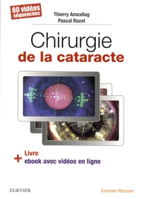 Chirurgie de la cataracte