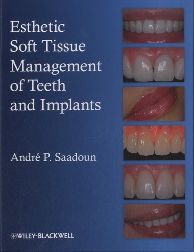 André P. Saadoun - Esthetic Soft Tissue Management of Teeth and Implants.