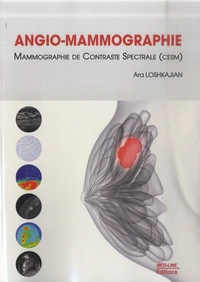 Angio-mammographie