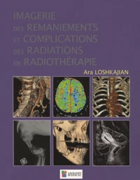 Imagerie des remaniements et complications des radiations en radiothérapie