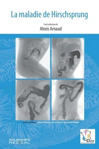 La maladie de Hirschsprung