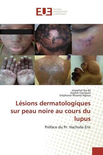 Ba josaphat Iba - Lésions dermatologiques sur peau noire au cours du lupus.