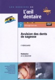 Franck Renouard et Gérard Baudoin - Avulsion des dents de sagesse. 1 DVD