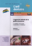 D Etienne et P Bouchard - L'approche latérale de la greffe sinusienne. 1 DVD