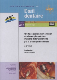 Gérard Baudoin - Greffe de comblement sinusien et mise en place de deux implants de large diamètre par la technique non-enfoui. 1 DVD