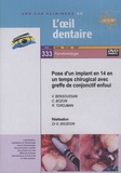 Gérard Baudoin - Pose d'un implant en 14 en un temps chirugical avec greffe de conjonctif enfoui. 1 DVD