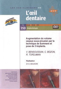 V Bensoussan et C Bozon - Augmentation du volume osseux sous-sinusien par la technique de Summers et pose de 3 implants. 1 DVD