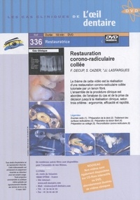 Restauration corono-radiculaire collée  1 DVD
