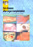Alain Claudy et  Collectif - Skin diseases after organ transplatation.