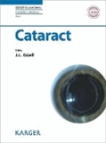 Cataract.