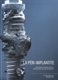 Eduardo Anitua Aldecoa - La péri implantite - Une nouvelle approche de la prévention et de son traitement.