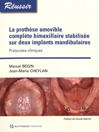 La prothèse amovible complète bimaxillaire stabilisée sur deux implants mandibulaires