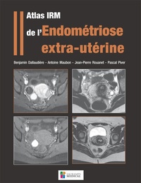 Benjamin Dallaudière et Antoine Maubon - Atlas IRM de l'endométriose extra-utérine.