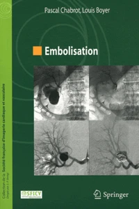Embolisation