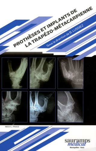 Bruno Lussiez - Prothèses et implants de la trapézo-métacarpienne.