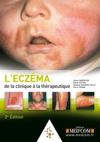 L'eczéma