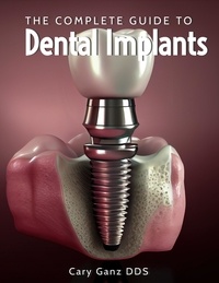  Cary Ganz D.D.S. - The Complete Guide to Dental Implants - All About Dentistry.
