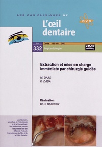 Gérard Baudoin - Extraction et mise en charge immédiate par chirurgie guidée. 1 DVD