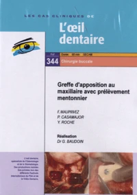 Greffe d'apposition au maxillaire avec prélèvement mentonnier