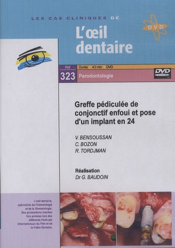Gérard Baudoin - Greffe pédiculée de conjonctif enfoui et pose d'un implant en 24. 1 DVD