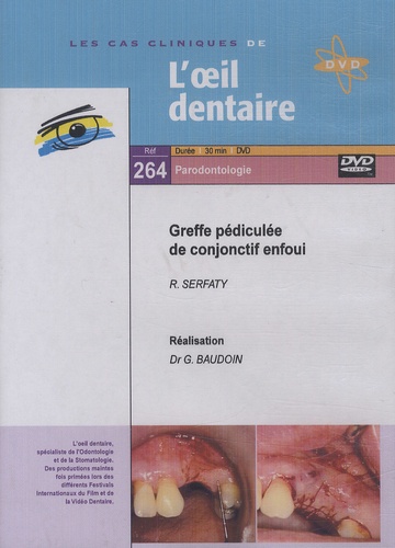 Gérard Baudoin - Greffe pédiculée de conjonctif enfoui. 1 DVD