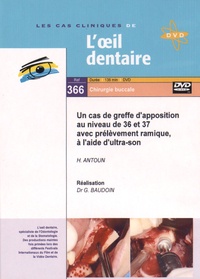 Hadi Antoun et Gérard Baudoin - Un cas de greffe d'apposition au niveau de 36 et 37 avec prélèvement ramique, à l'aide d'ultra-son. 1 DVD
