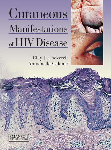 Clay J Cockerell - Cutaneous Manifestations of HIV Disease.