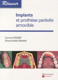 Corinne Taddéi et Etienne Waltmann - Implants et prothèse partielle amovible.