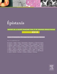 Epistaxis