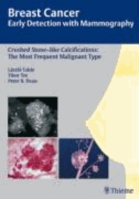 Crushed Stone-like Calcifications: The Most Frequent Malignant Type - Breast Cancer: Early Detection with Mammography.