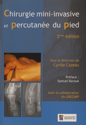 Cyrille Cazeau - Chirurgie mini-invasive et percutanée du pied.