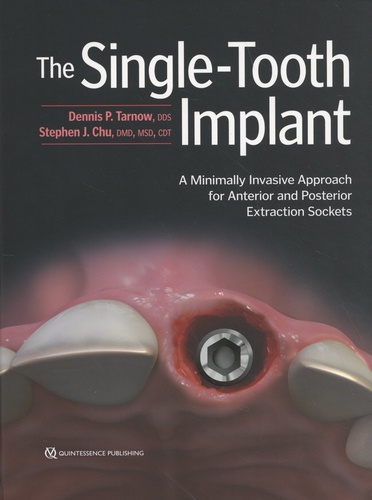 The Single-Tooth Implant. A Minimally Invasive Approach for Anterior and Posterior Extraction Sockets