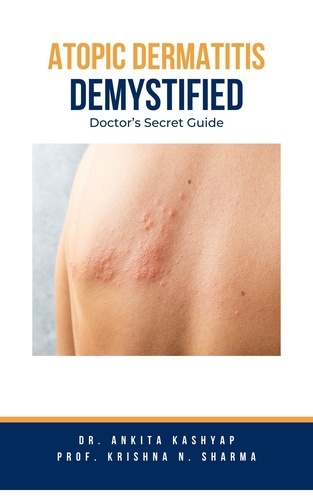 Dr. Ankita Kashyap et  Prof. Krishna N. Sharma - Atopic Dermatitis Demystified: Doctor's Secret Guide.