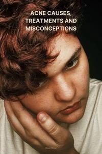 Acne causes,  treatments and misconceptions