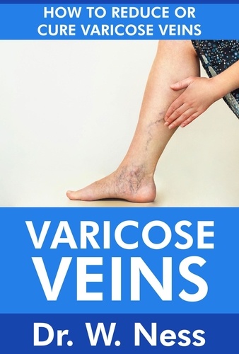  Dr. W. Ness - Varicose Veins: How To Reduce Or Cure Varicose Veins.