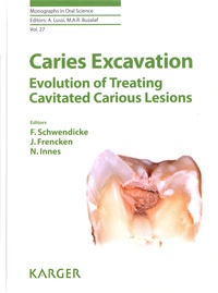 Falk Schwendicke et Jo Frencken - Caries Excavation - Evolution of Treating Cavitated Carious Lesions.