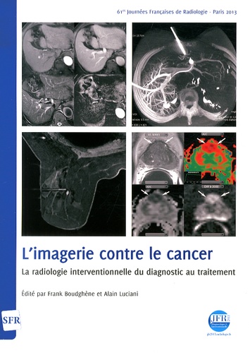 Frank Boudghène et Alain Luciani - L'imagerie contre le cancer - La radiologie interventionnelle du diagnostic au traitement. 1 Cédérom