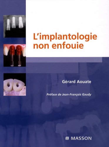 Gérard Aouate - L'implantologie non enfouie.