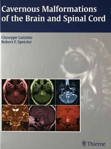 Giuseppe Lanzino et Robert F. Spetzler - Cavernous Malformations of the Brain and Spinal Cord.