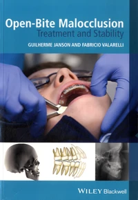Open-Bite Malocclusion