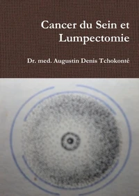 Cancer du Sein et Lumpectomie