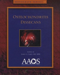 James-L Carey - Osteochondritis Dissecans.