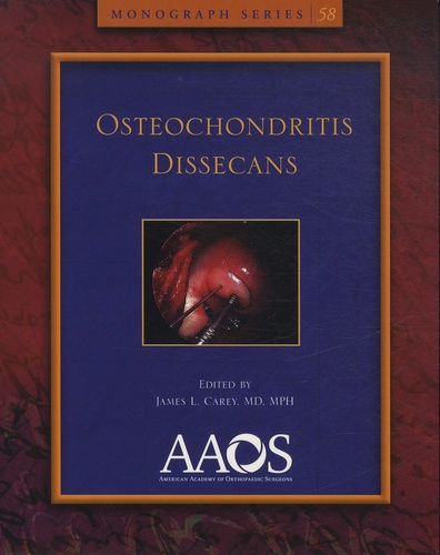 James-L Carey - Osteochondritis Dissecans.
