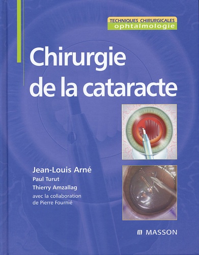 Jean-Louis Arné et Paul Turut - Chirurgie de la cataracte.