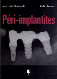 Jean-Louis Giovannoli et Stefan Renvert - Péri-implantites.