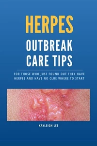 Herpes Outbreak Care Tips: For Those Who Just Found Out They Have Herpes and Have No Clue Where to Start