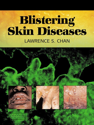 Lawrence S Chan - Blistering Skin Diseases.