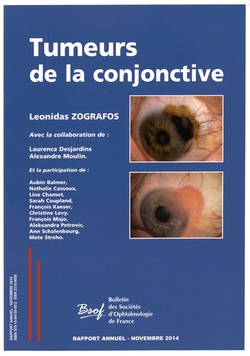 Leonidas Zografos - Tumeurs de la conjonctive.
